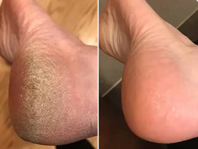 Me daba vergüenza mostrar mis pies