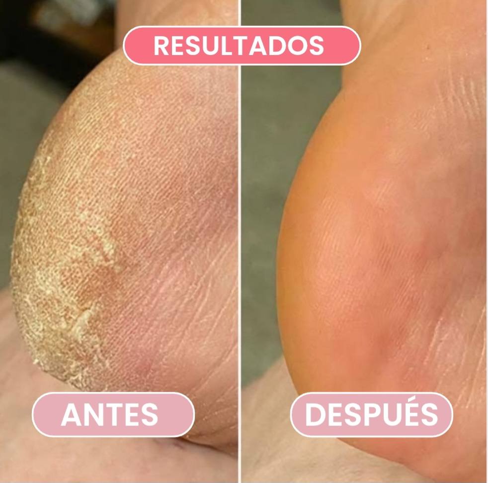 Removedor de callos-Pies suaves y cuidados