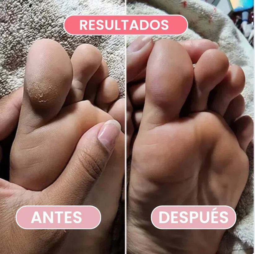 Removedor de callos-Pies suaves y cuidados
