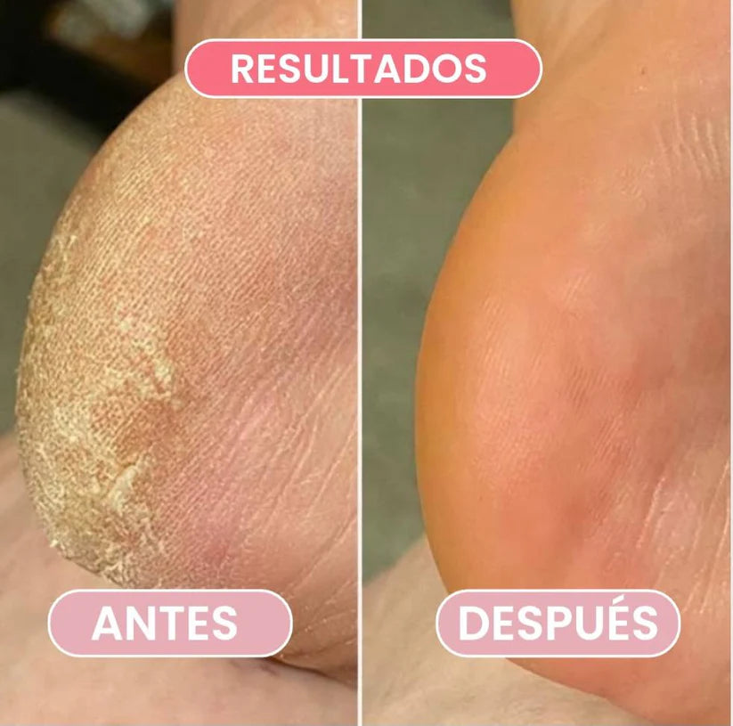 Removedor de callos-Pies suaves y cuidados